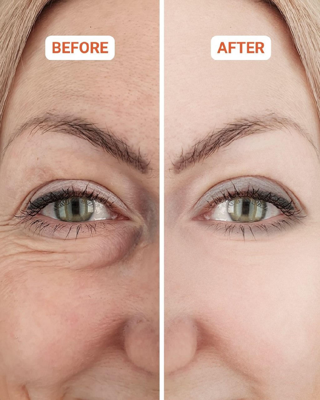 MedSpa before and after eye area treatment results