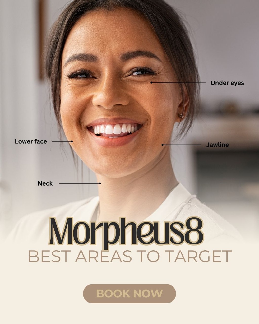 Morpheus8 best treatment areas educational post